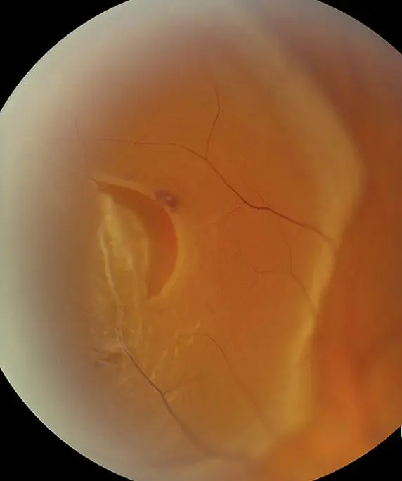 網膜裂孔/網膜剥離 Retinal Detachment | 横浜井土ヶ谷アイクリニック