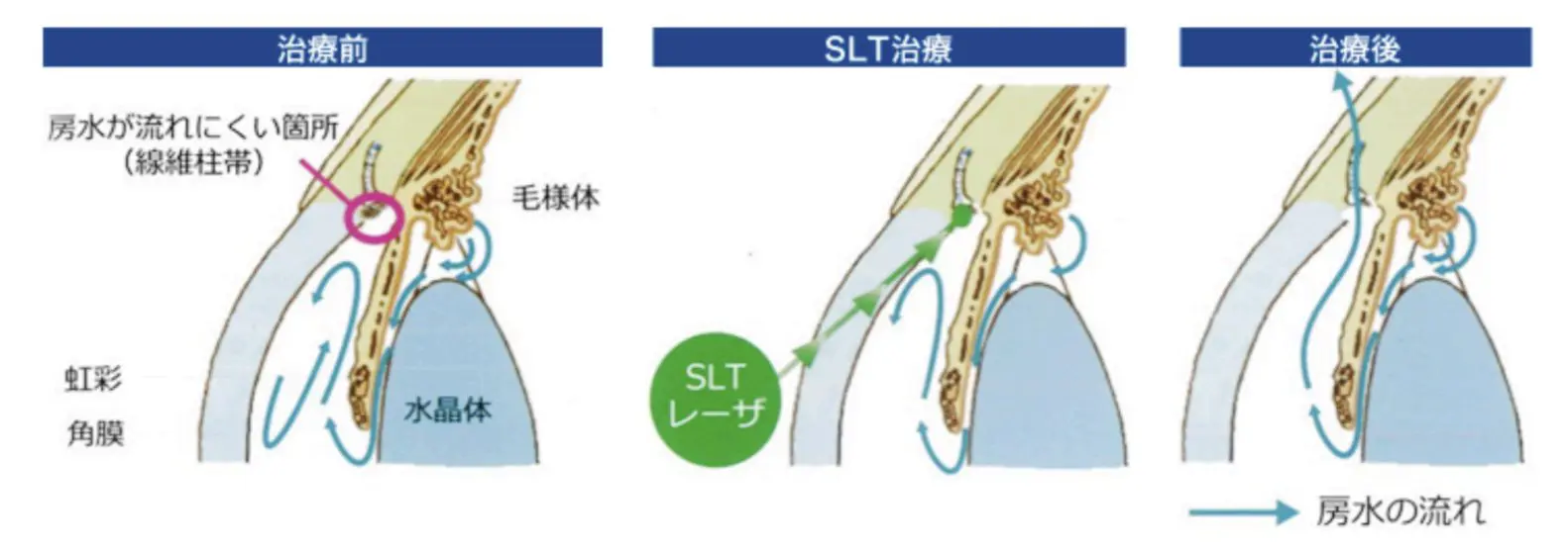 緑内障手術 Glaucoma Surgery | 横浜井土ヶ谷アイクリニック