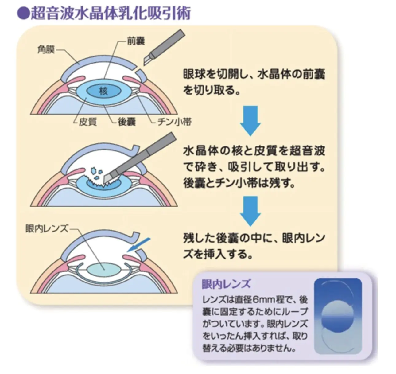 白内障手術 Cataract Surgery | 横浜井土ヶ谷アイクリニック