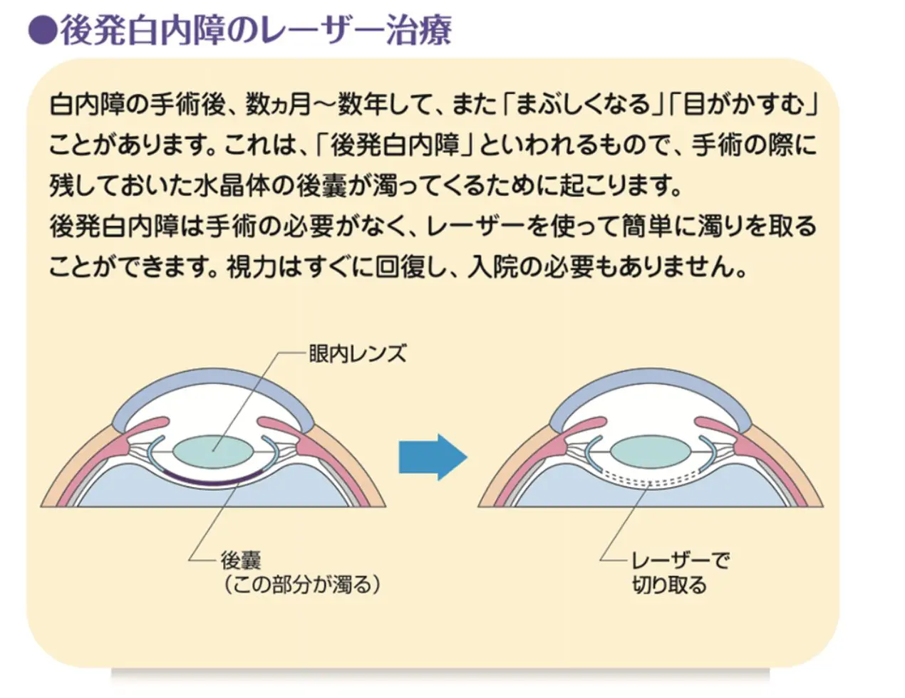 白内障手術 Cataract Surgery | 横浜井土ヶ谷アイクリニック