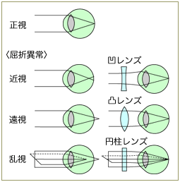 屈折異常(近視・遠視・乱視) Ametropia | 横浜井土ヶ谷アイクリニック